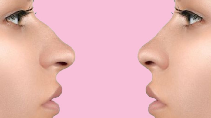 Nose Rhinoplasty